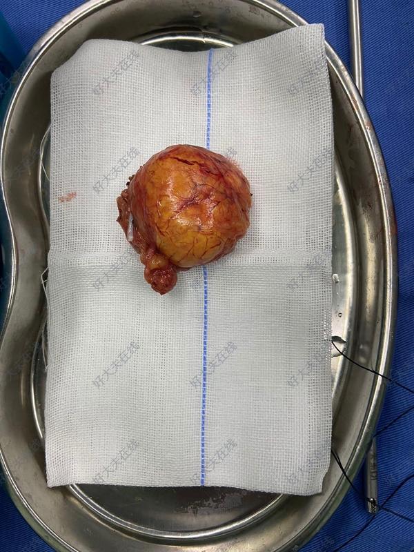 微创肾上腺肿瘤手术_肾上腺肿瘤 - 好大夫在线