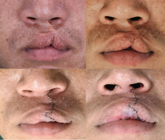 【科普】90%唇裂一期患者,出现继发畸形, 被叫豁嘴