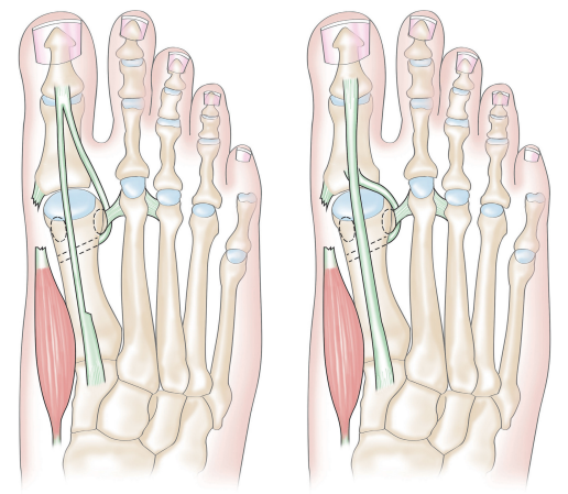 如果患者拇长伸肌腱和拇短伸肌腱已经损伤,那么需要拇展肌进行转位