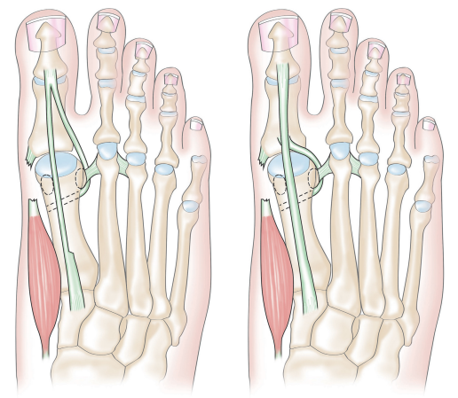 足拇长屈肌腱解剖图图片