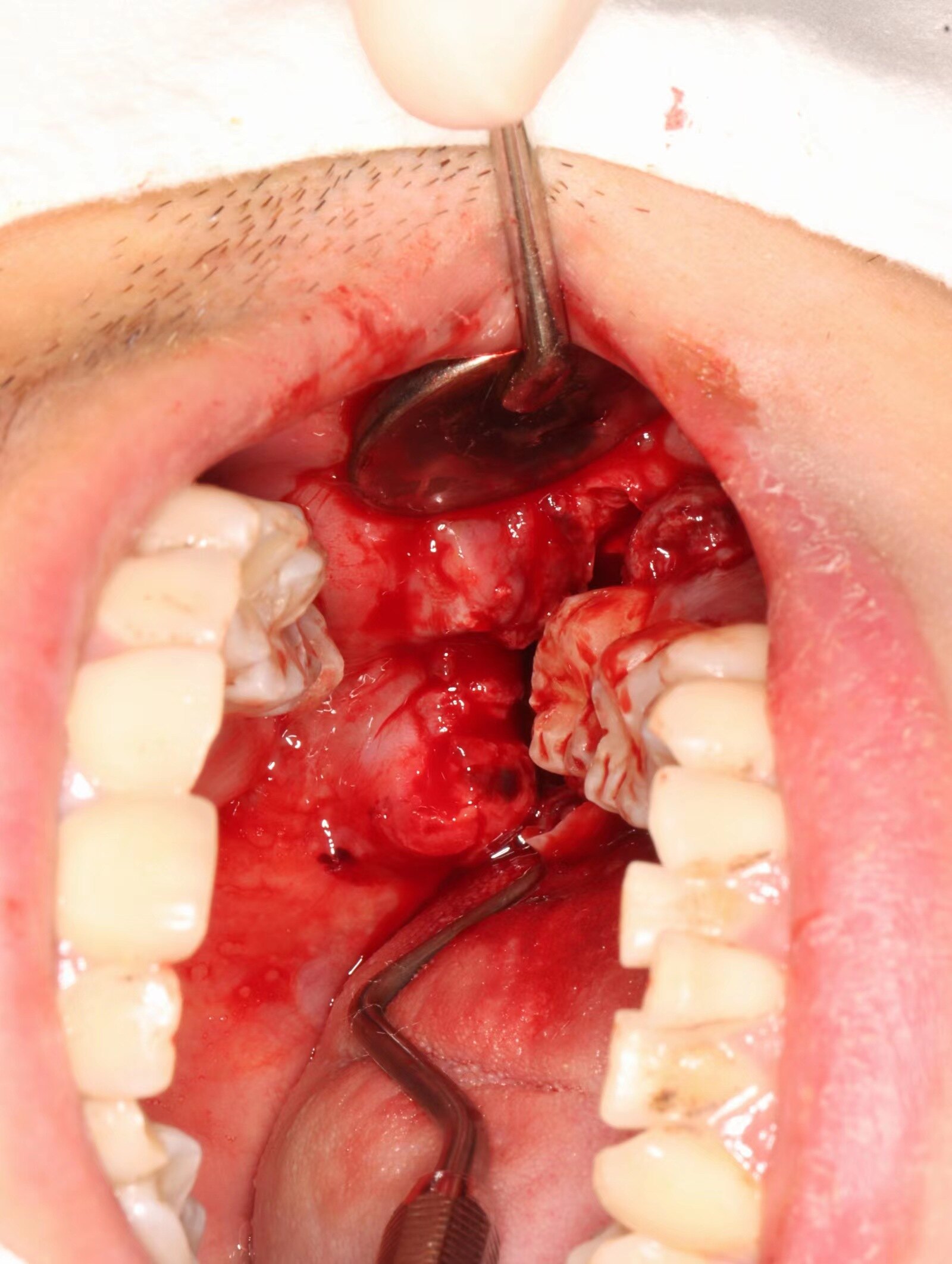牙根进入舌侧间隙该怎么办呢