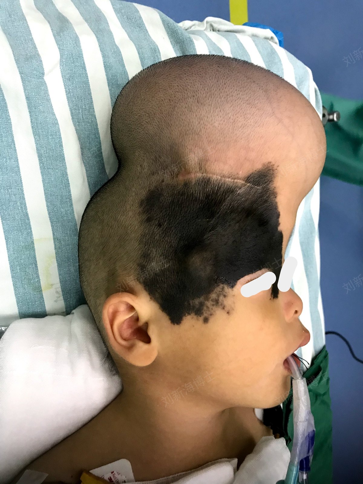 头面部巨痣 皮肤扩张 术后恢复全过程 - 好大夫在线