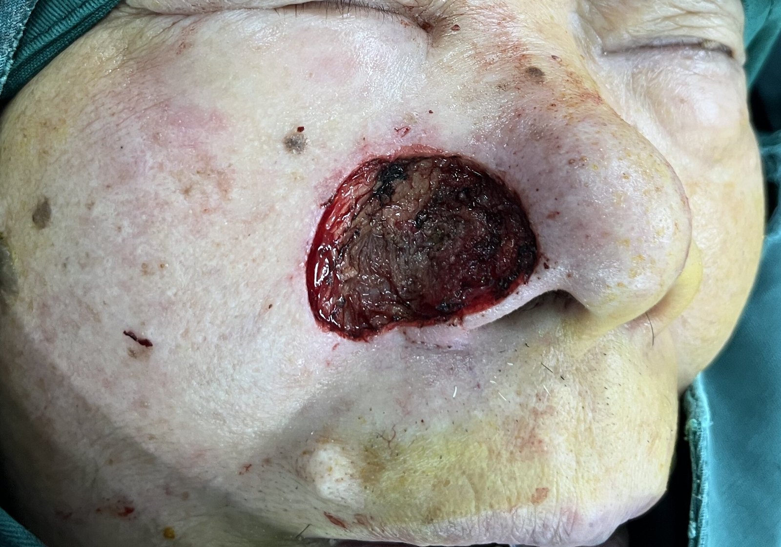 鼻翼肿瘤切除后鼻唇沟皮瓣修复重建