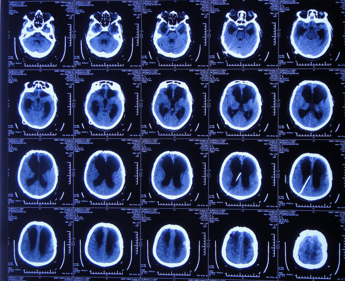 行头颅ct(片子遗失)检查示双额叶脑挫裂伤,少量出血