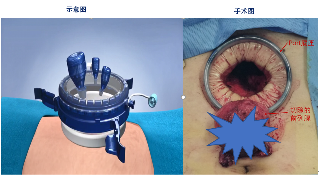 您需要了解的前列腺癌根治手术之单孔前列腺癌根治术_前列腺癌_前列