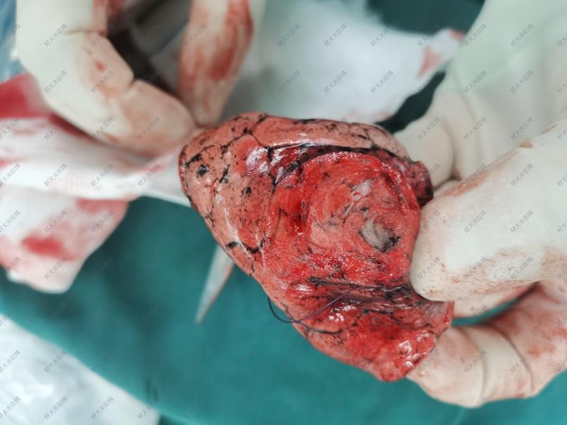 肺结节精准定位,切除_肺部结节 - 好大夫在线