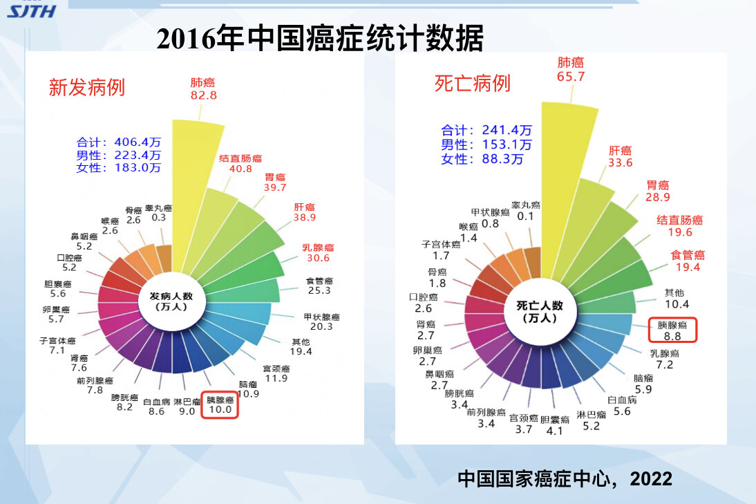 使用新方法 胰腺癌可以提前三年被诊断出来 - 好大夫在线