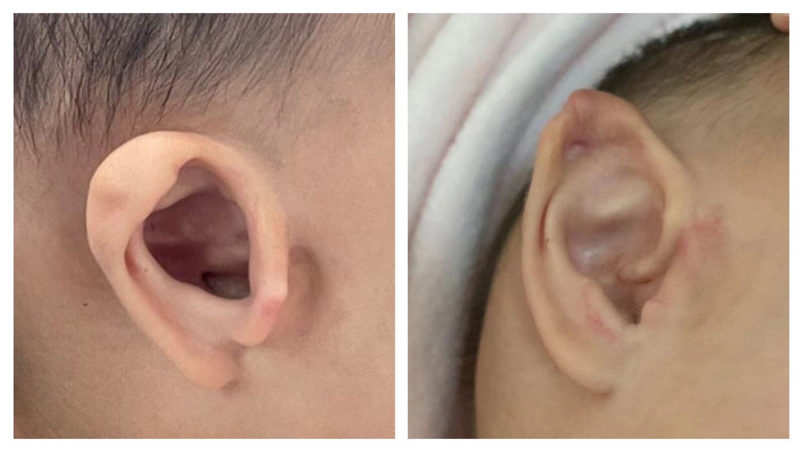 真正的诊断应该是一二鳃弓综合征,或者7号面裂,这种往往一出生的时候