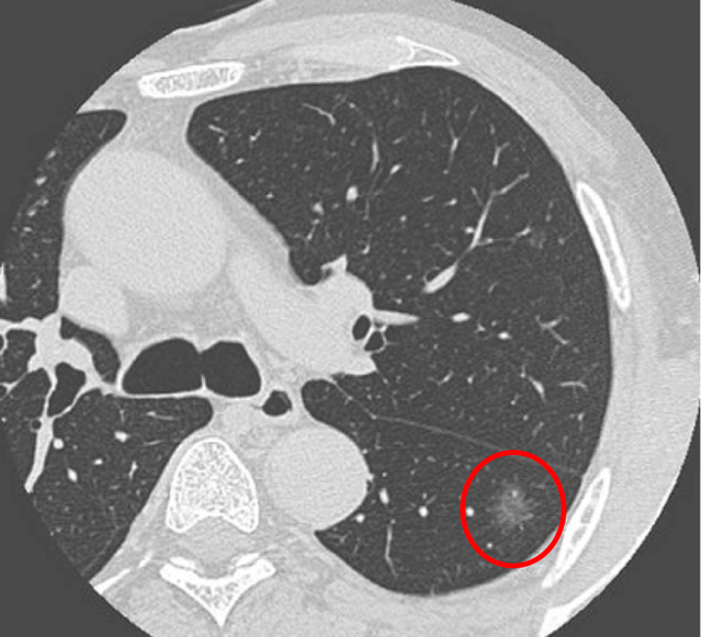 肺结节科普:肺部长了"磨玻璃结节"应该怎么办?
