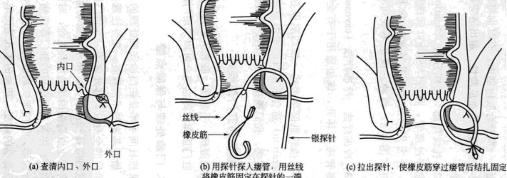复杂肛瘘手术挂线图图片