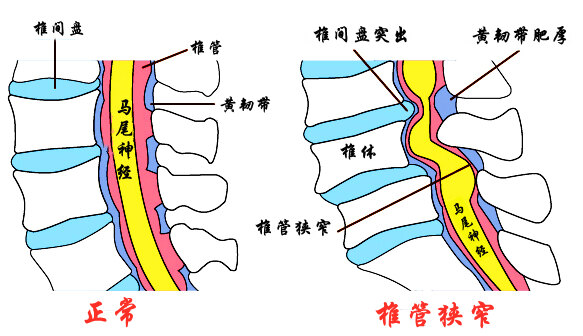 腰椎管狭窄图解图片