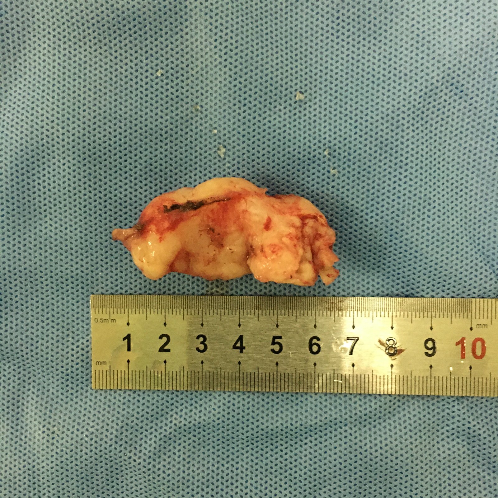 需与食管癌相鉴别良性肿瘤疾病(食管平滑肌瘤).