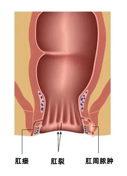 乳腺导管瘘的症状图片