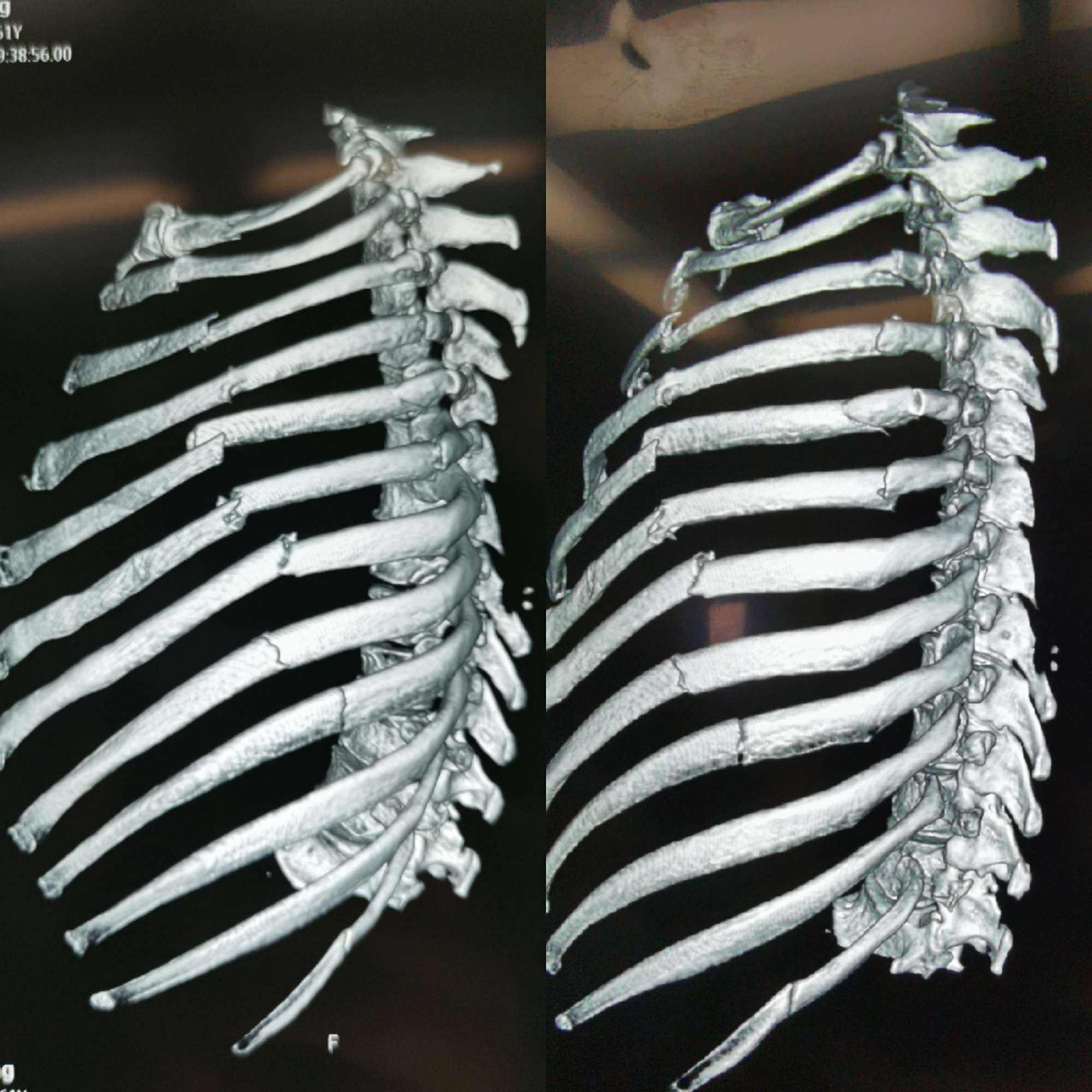 左侧肋骨凹陷图片图片