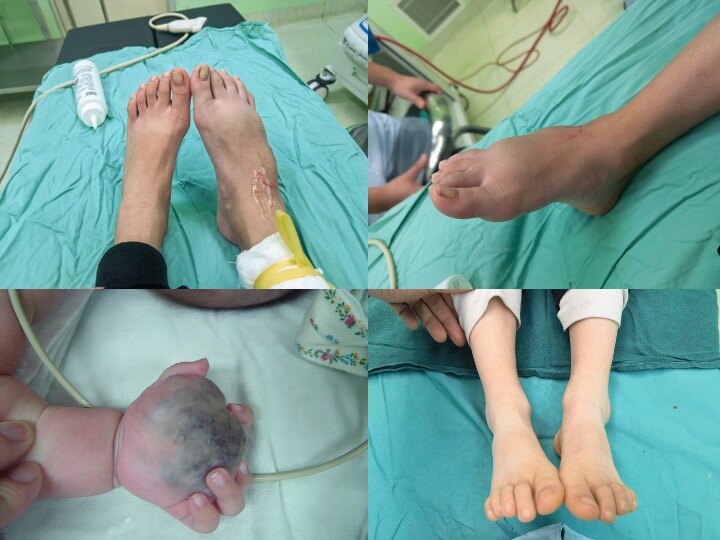 下肢淋巴管瘤图片图片