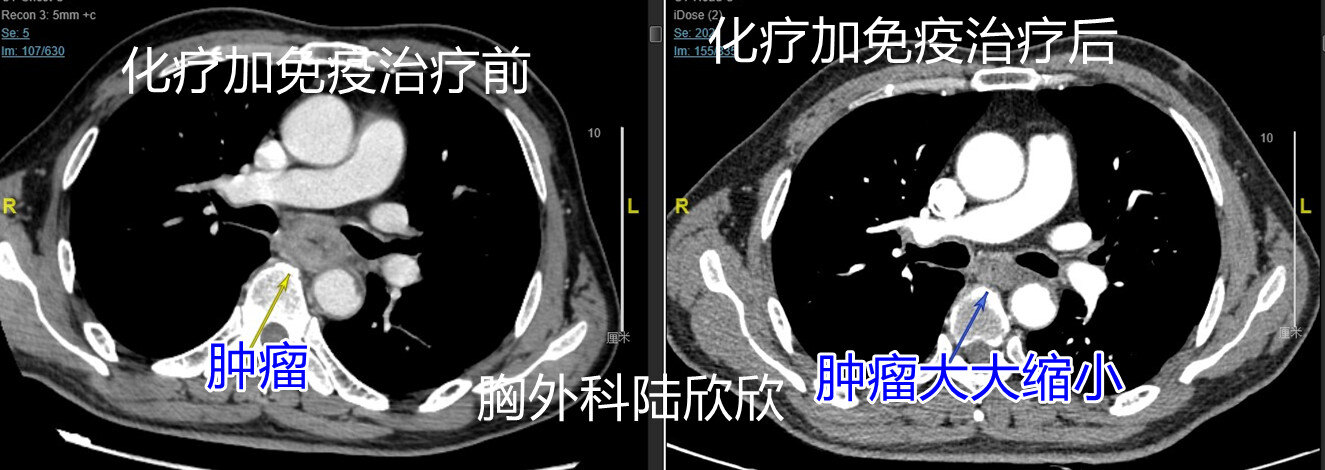 左主支气管平面对比水印.jpg