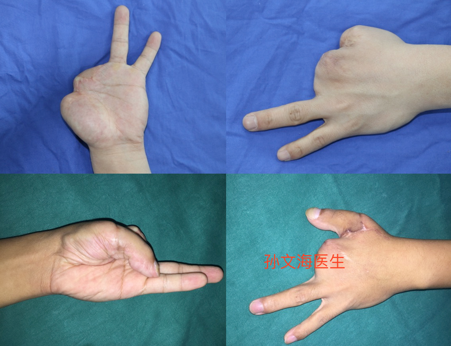 拇手指再造附案例集