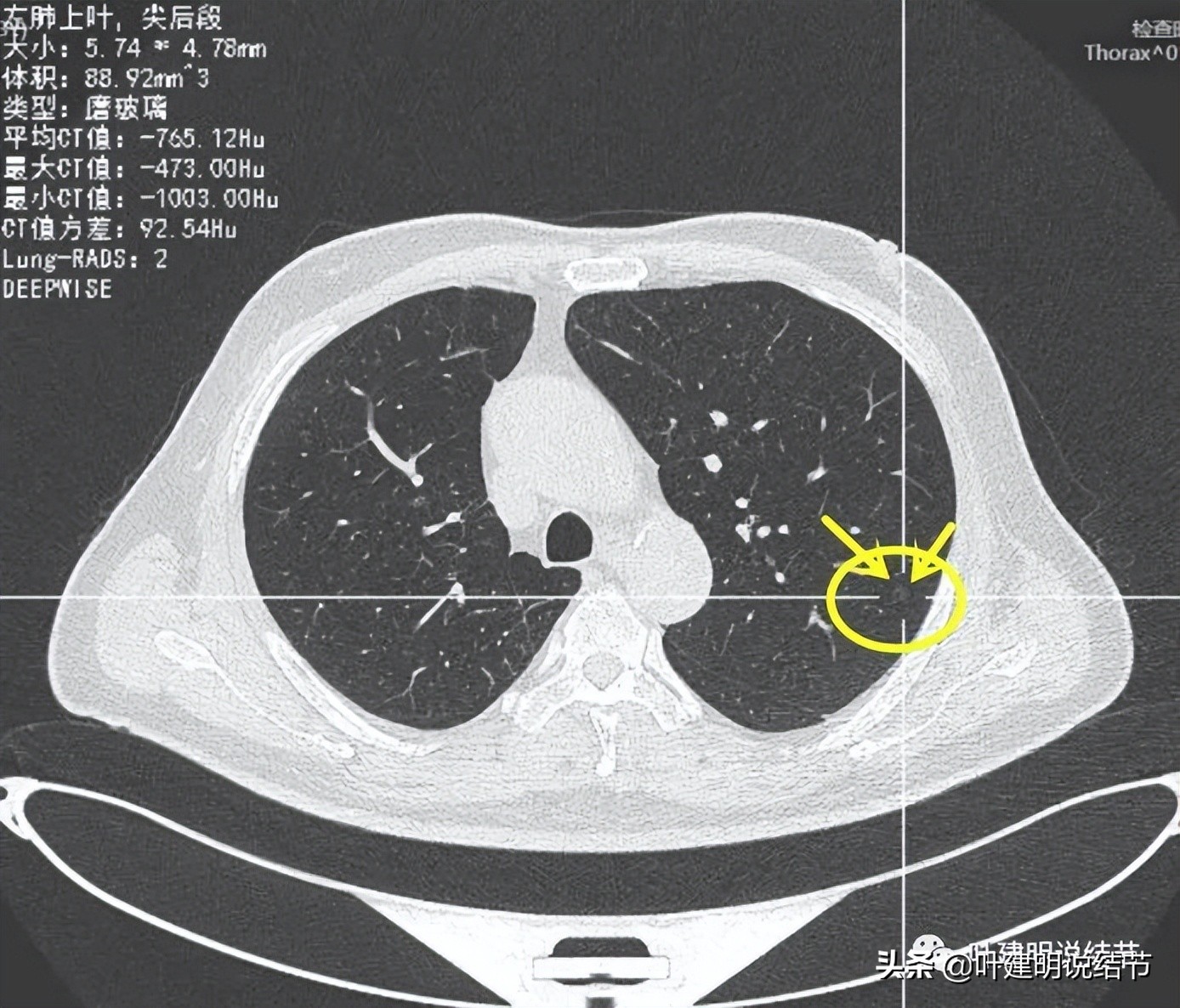 觀點:引入人工智能ai診斷肺結節,到底是利是弊?