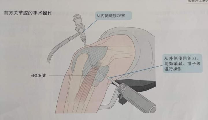 网球肘封闭注射图解图片