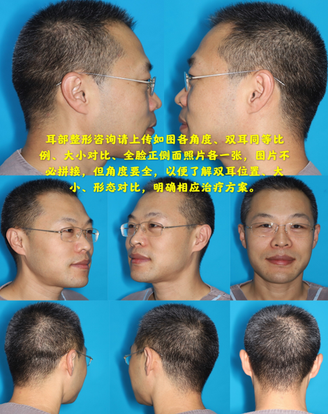 耳畸形修复手术及耳再造术前评估的细节及手术方案设计 好大夫在线 耳畸形修复手术及耳再造术前评估的细节及手术方案设计 好大夫在线