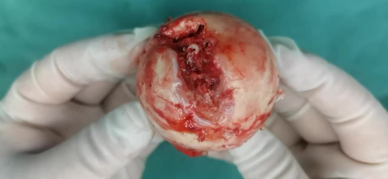 刚塌陷的股骨头肉眼所见_股骨头坏死_股骨头坏死介绍 - 好大夫在线