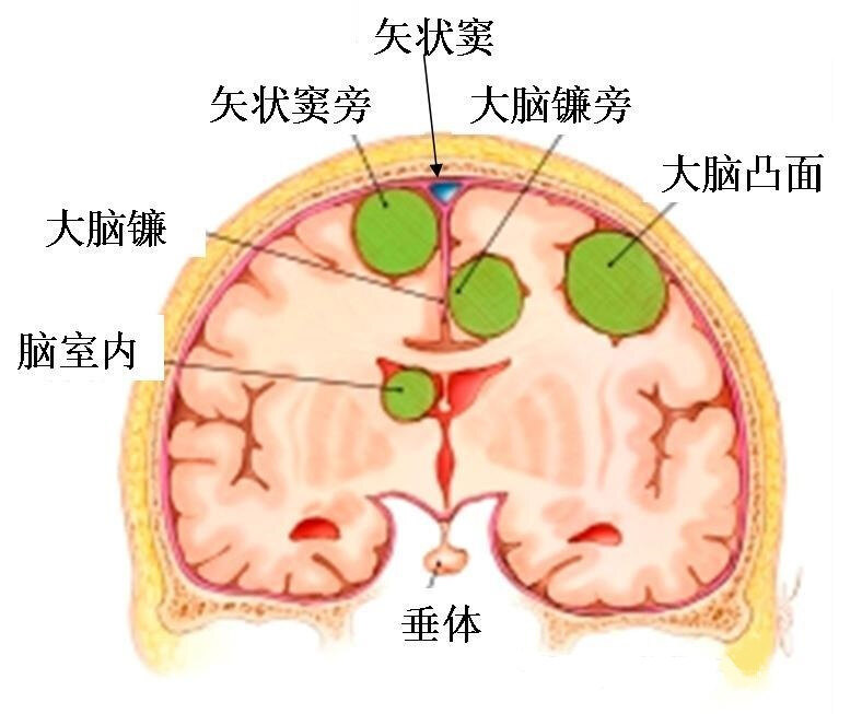 大脑镰旁者也比较多见,其次为蝶骨嵴,鞍结节,嗅沟,小脑桥脑角与小脑幕