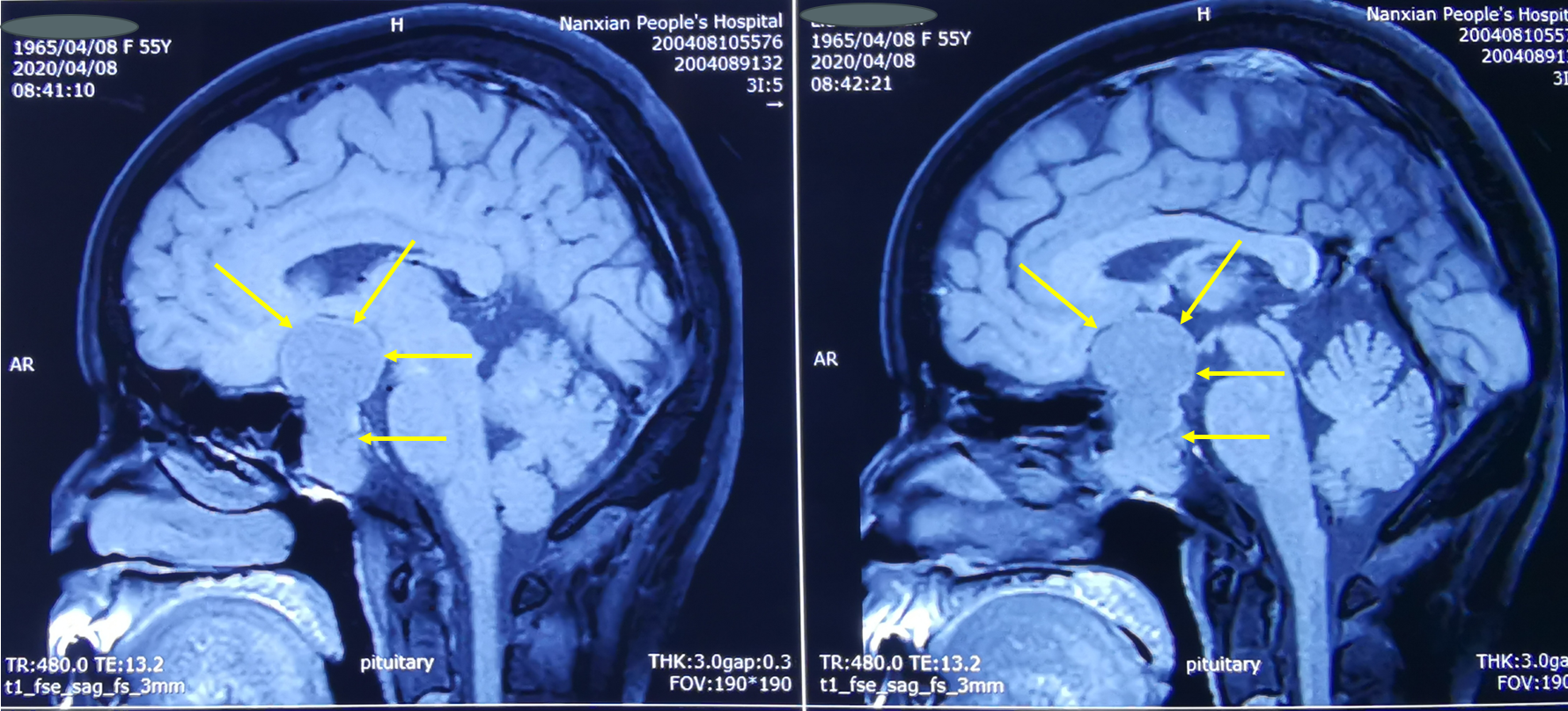 腫瘤為無功能性腫瘤,不分泌內分泌激素,影像學提示垂體腫瘤往鞍上生長