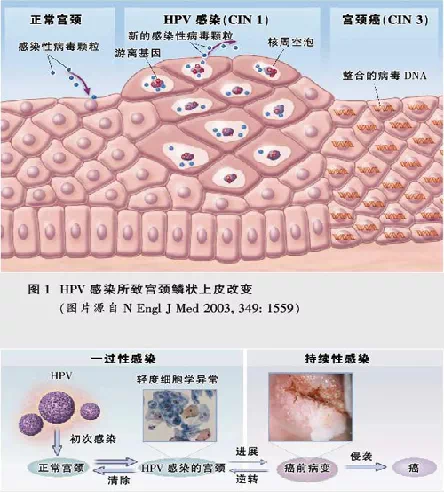 【专题精讲】hpv及子宫颈鳞状上皮低级别病变_hpv感染_介绍_治疗方式