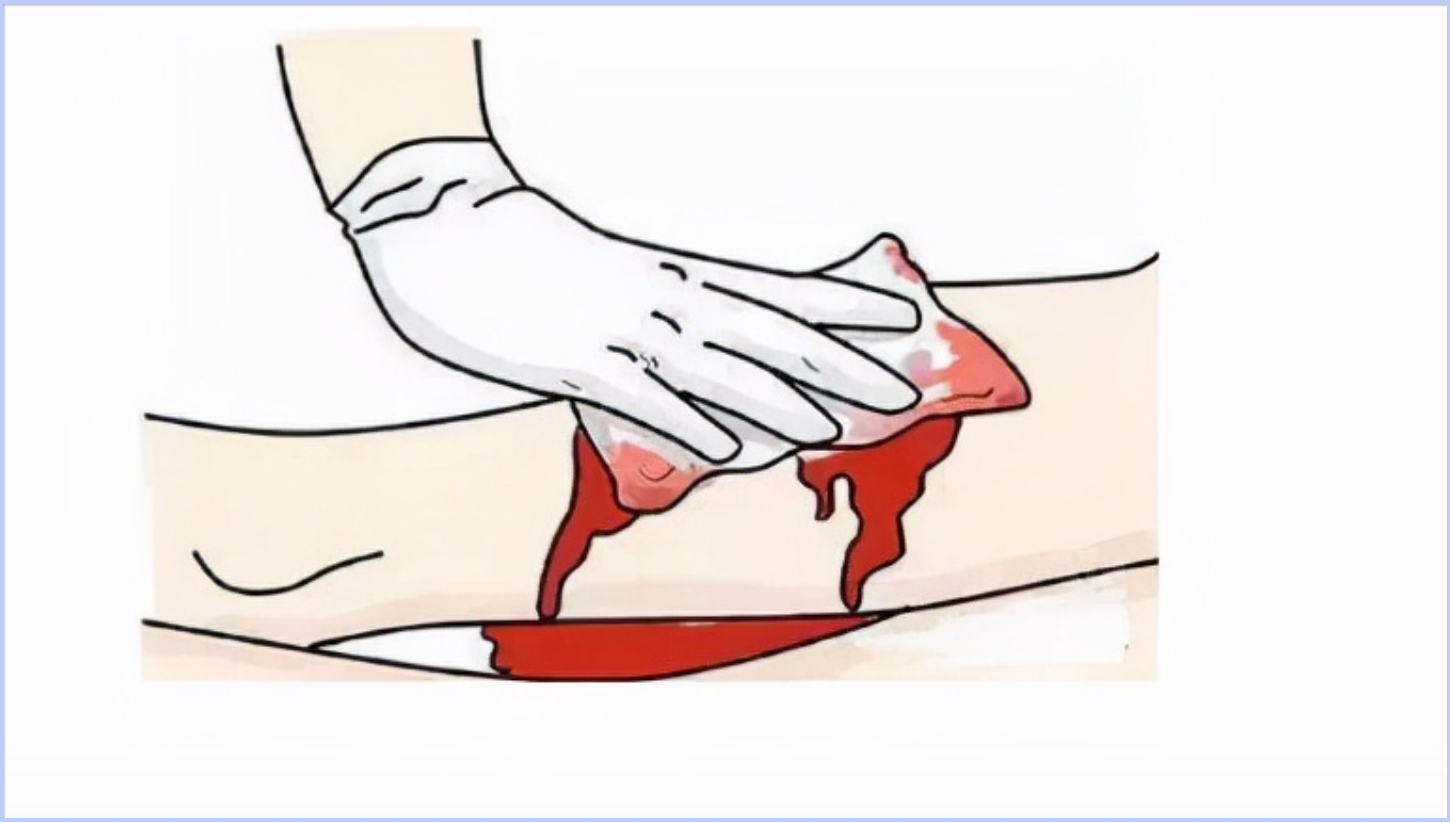 若血管瘤破溃出血,首先要做的处理就是止血.