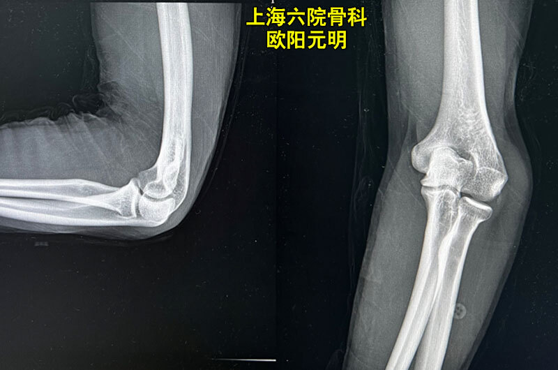 肘内翻是怎么回事 关节损伤 好大夫在线