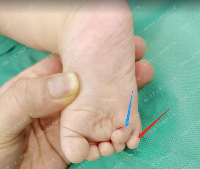 陈江海医生的科普号2022年03月25日15900宝宝右脚并趾,可以不植皮做分