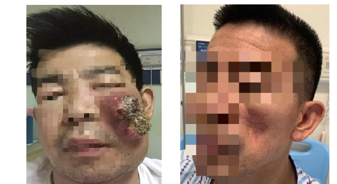 脸上长了颗"痘痘",竟是肺癌转移_肺癌_肺癌介绍 - 好大夫在线