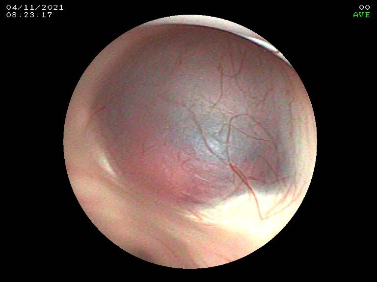 鞍上池囊肿合并双侧颞极蛛网膜囊肿相关性脑积水一例