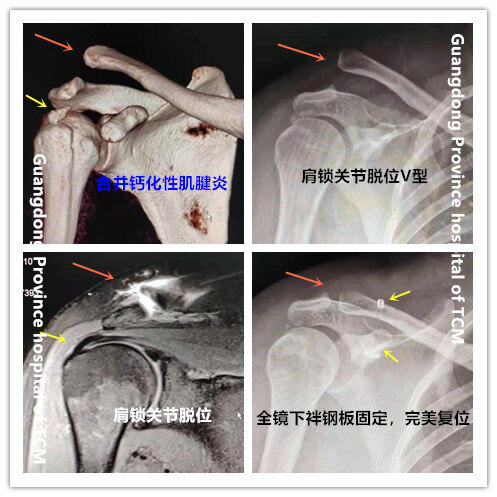 肩鎖關節脫位,我推薦關節鏡下袢鋼板固定——廣東省中醫院楊偉銘_肩鎖