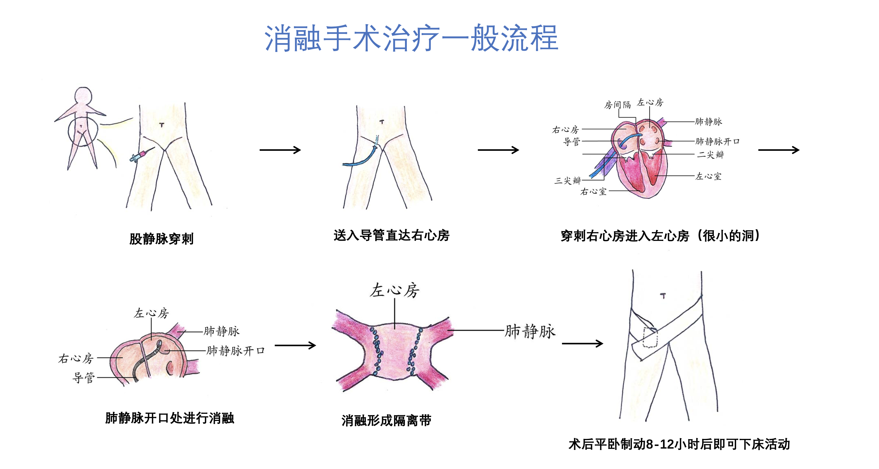 射频消融手术的一般流程