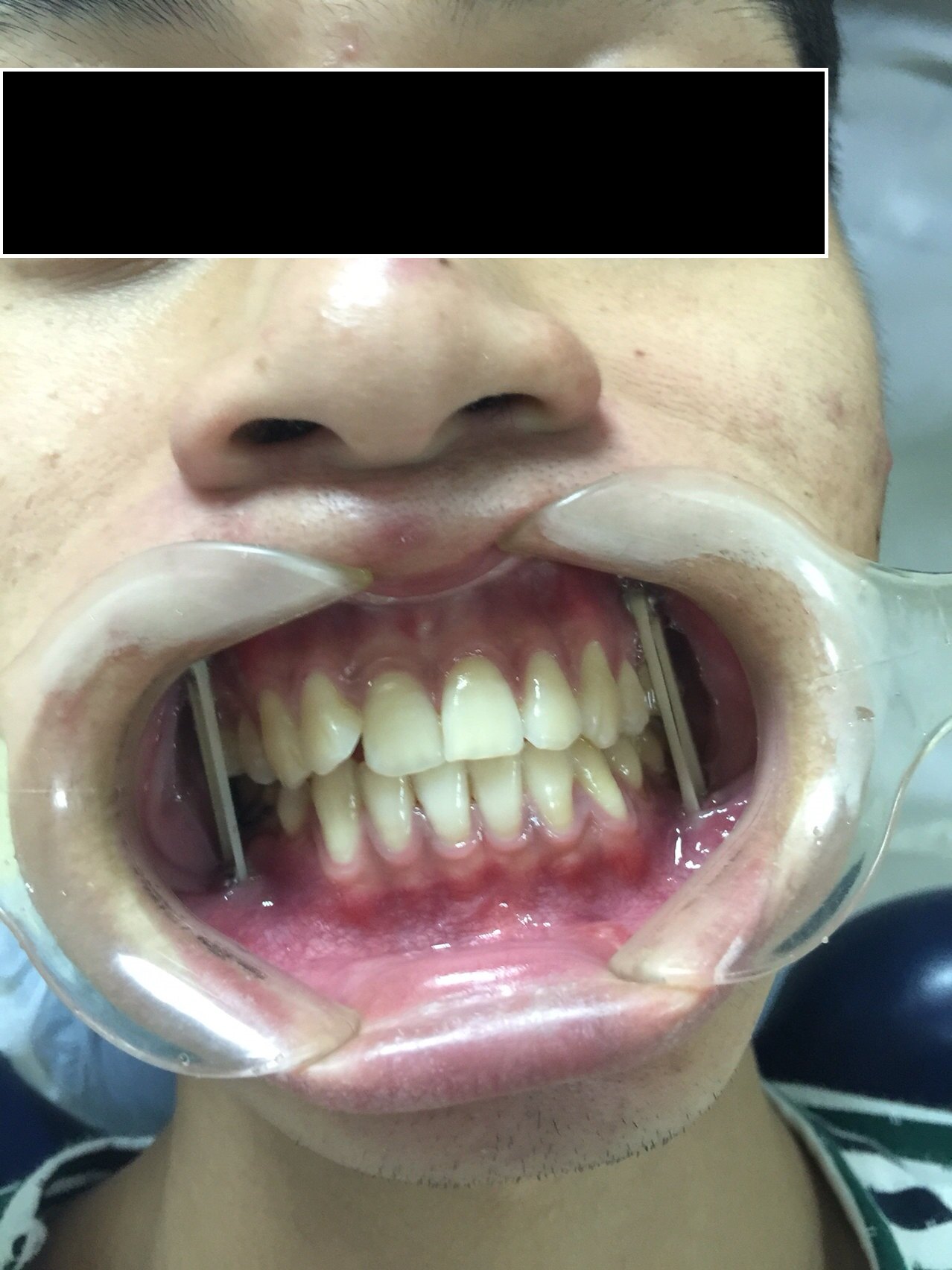 偏颌畸形手术矫正 - 好大夫在线