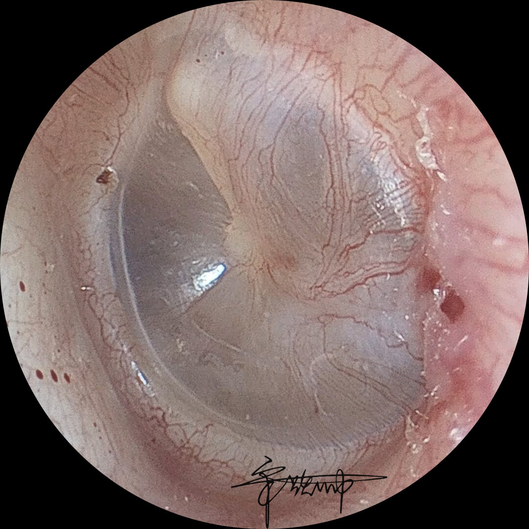 鼓膜外伤后7天患者女性,30余岁,左耳因外耳道气压突然增大引起鼓膜