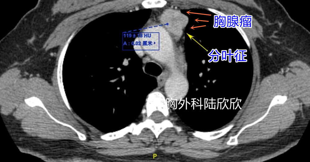 肿瘤中部分叶征与最大CT值水印.jpg