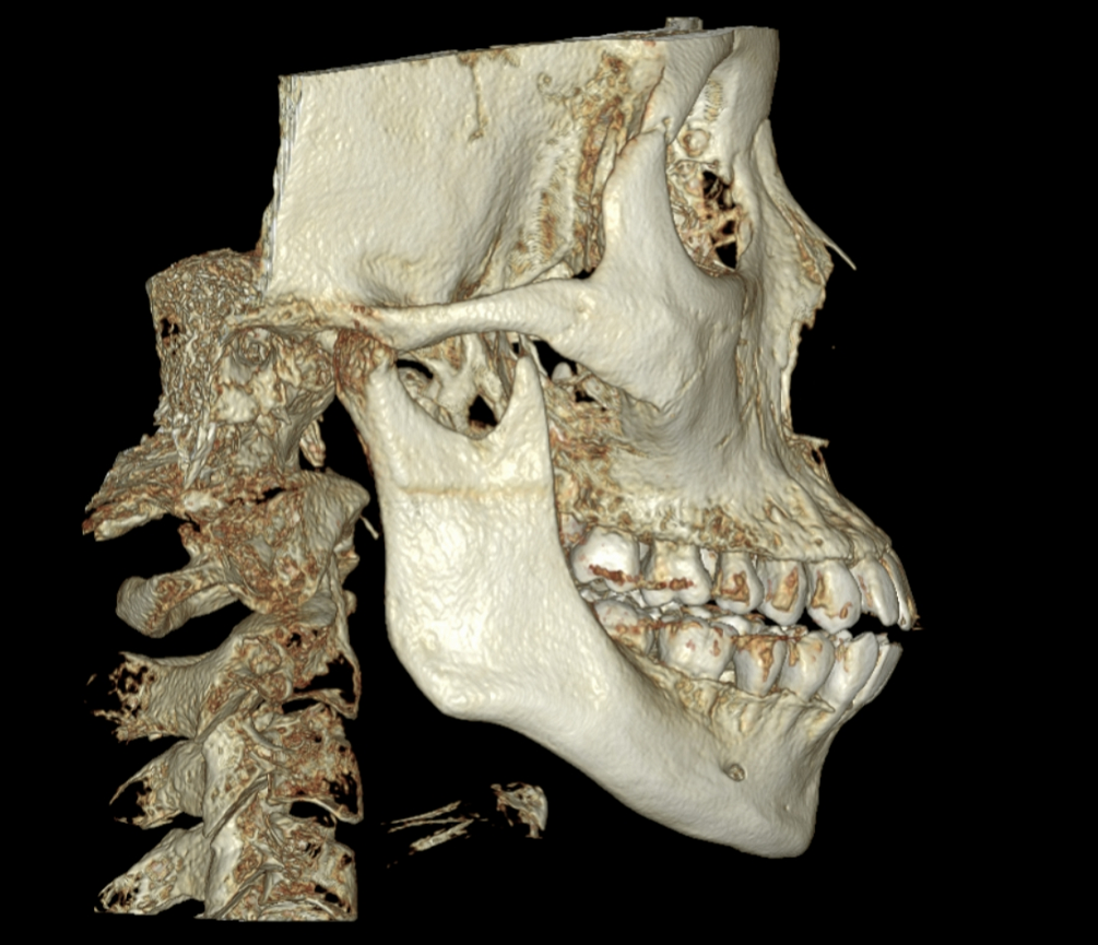 (照片为案例,我院拥有肖像使用权)_牙颌畸形_牙颌畸形治疗方式 - 好