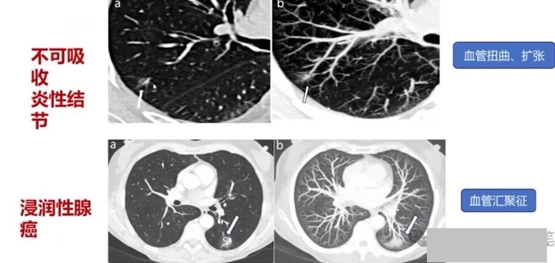 右肺上结节是癌吗 14YBAGZ8RRmAbqVSAAF5Zpe3rk0014.jpg?_ms_=0177