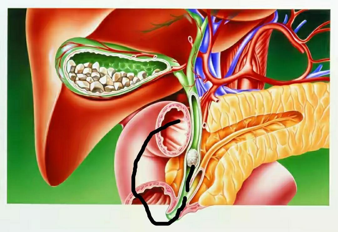 胆石症_胆结石_介绍_治疗方式 - 好大夫在线