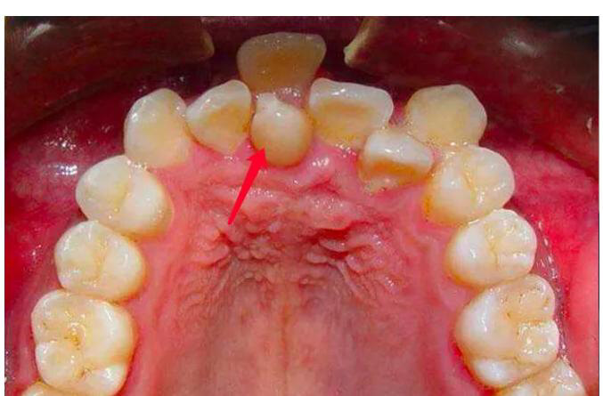 多生牙是什么原因图片