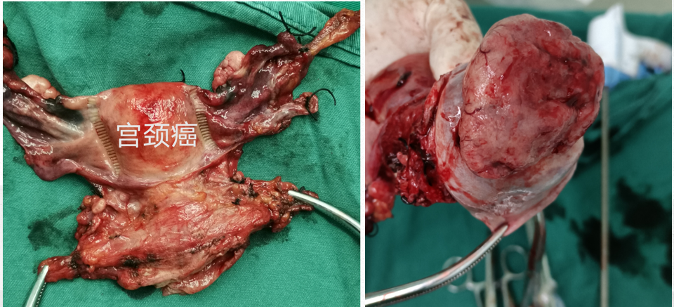 宫颈赘生物摘除术图片图片