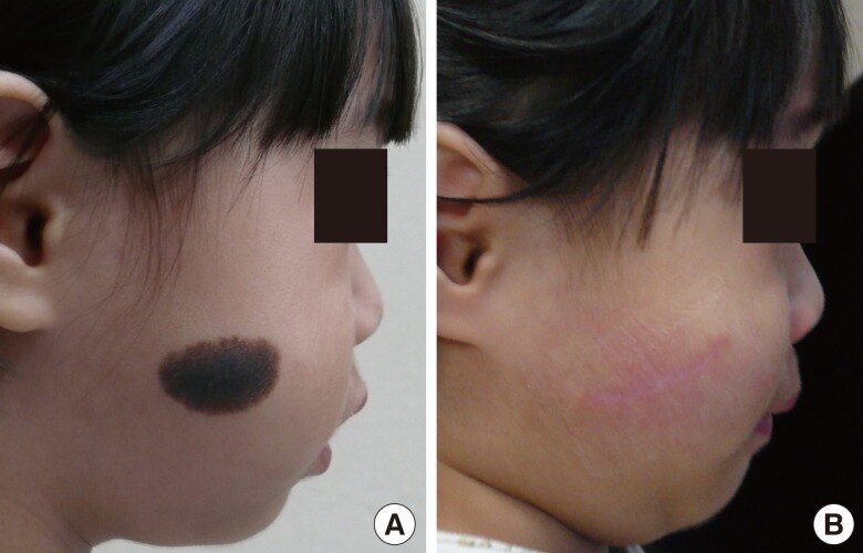 Congenital-melanocytic-nevus-on-the-right-cheek-A-Preoperative-photograph-37-mm21.png