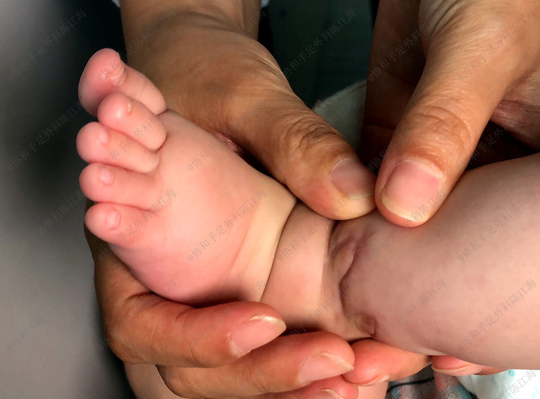 新手爸妈应该如何分辨婴儿肥和羊膜束带综合征?