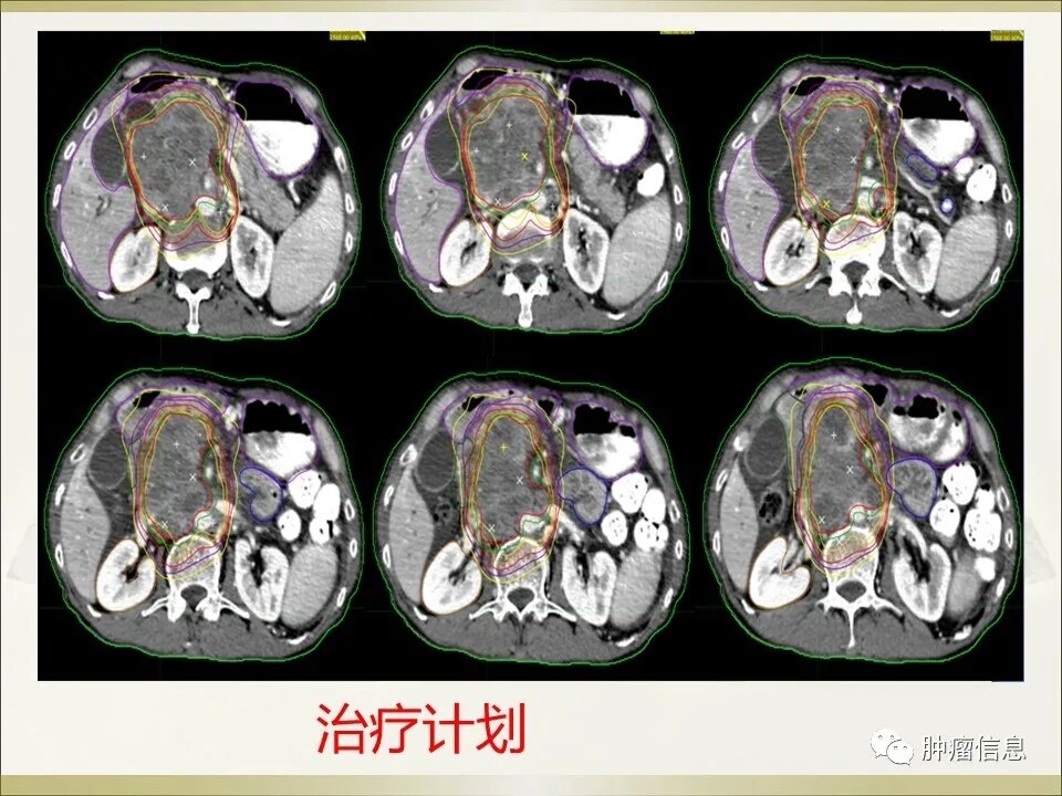 腹腔横纹肌肉瘤图片