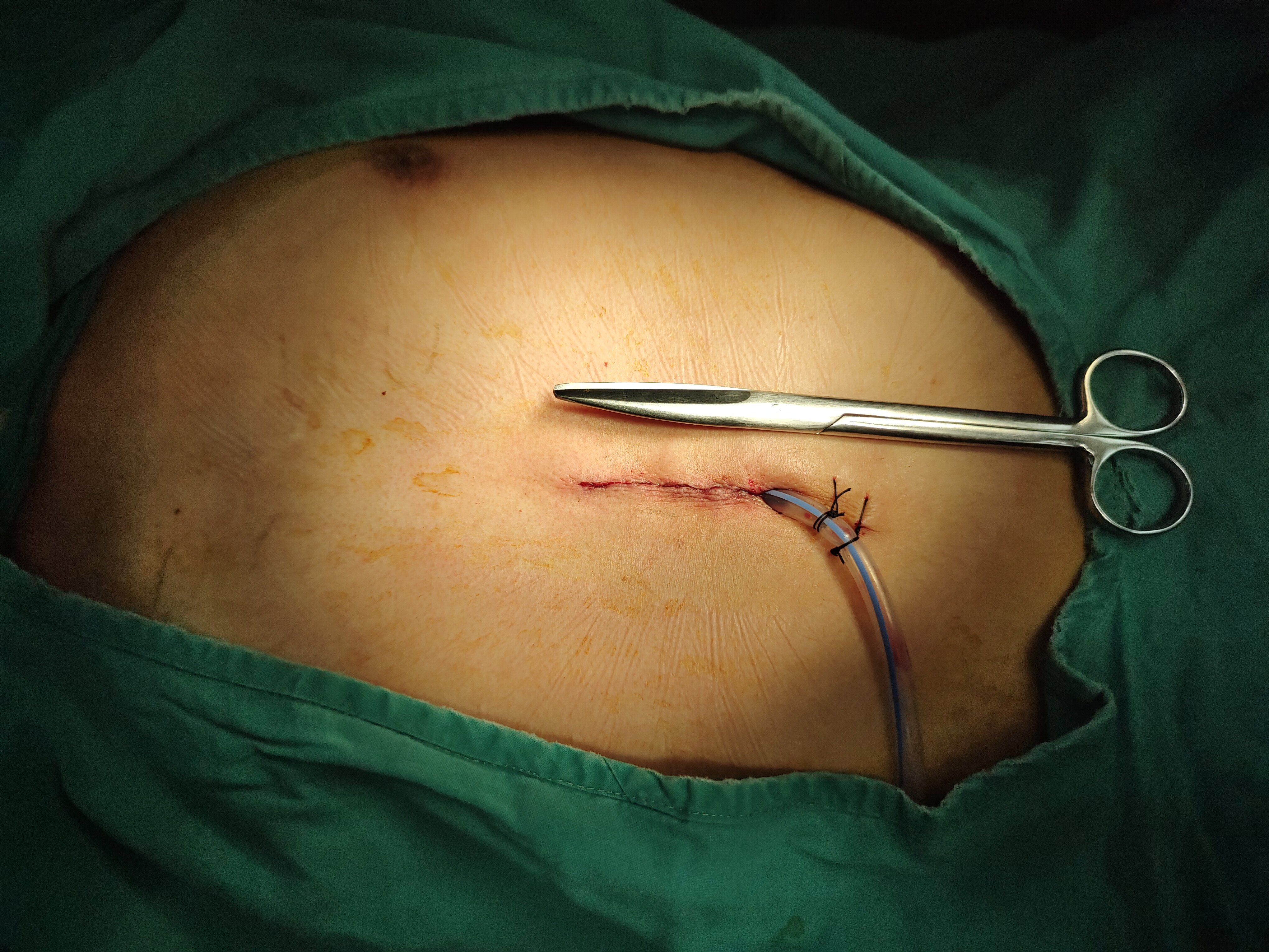 胸腺瘤微创手术图片