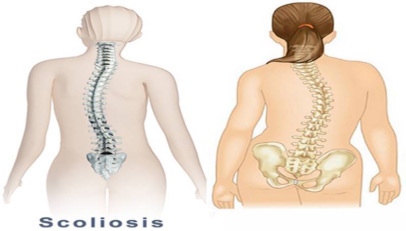 什么是脊柱侧弯_脊柱侧弯_介绍_症状表现_治疗方式 - 好大夫在线