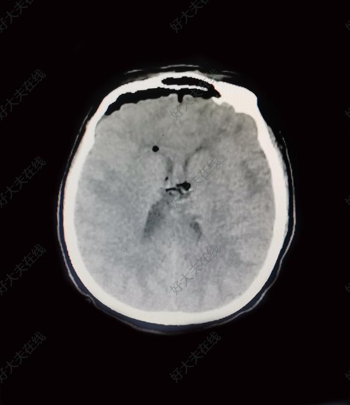 双侧胼胝体体部胶质瘤_胶质瘤 - 好大夫在线