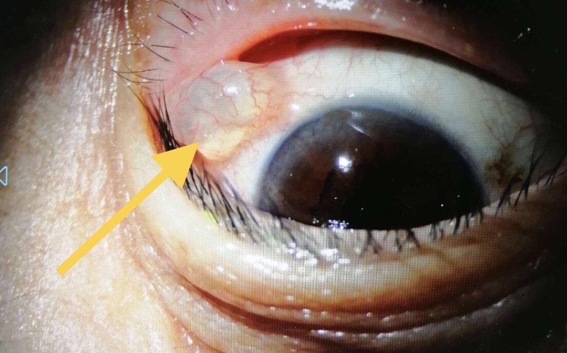 而上眼瞼的背面以及上結膜穹窿處腫物,因為普通人翻轉觀察並不容易